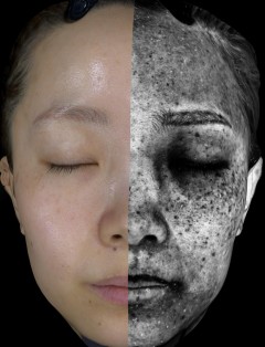 Ultraviolet Pigmentation Map