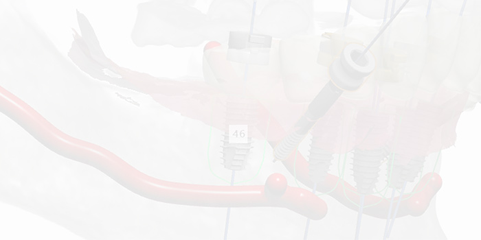 What are the benefits of using Truysou digital dental implants (2)6gy