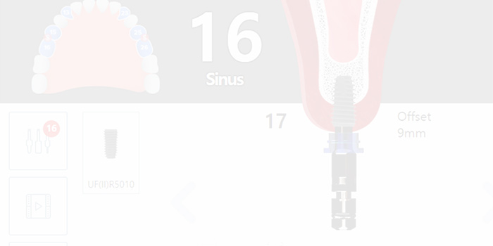 What are the benefits of using Truysou digital dental implants (3)ice