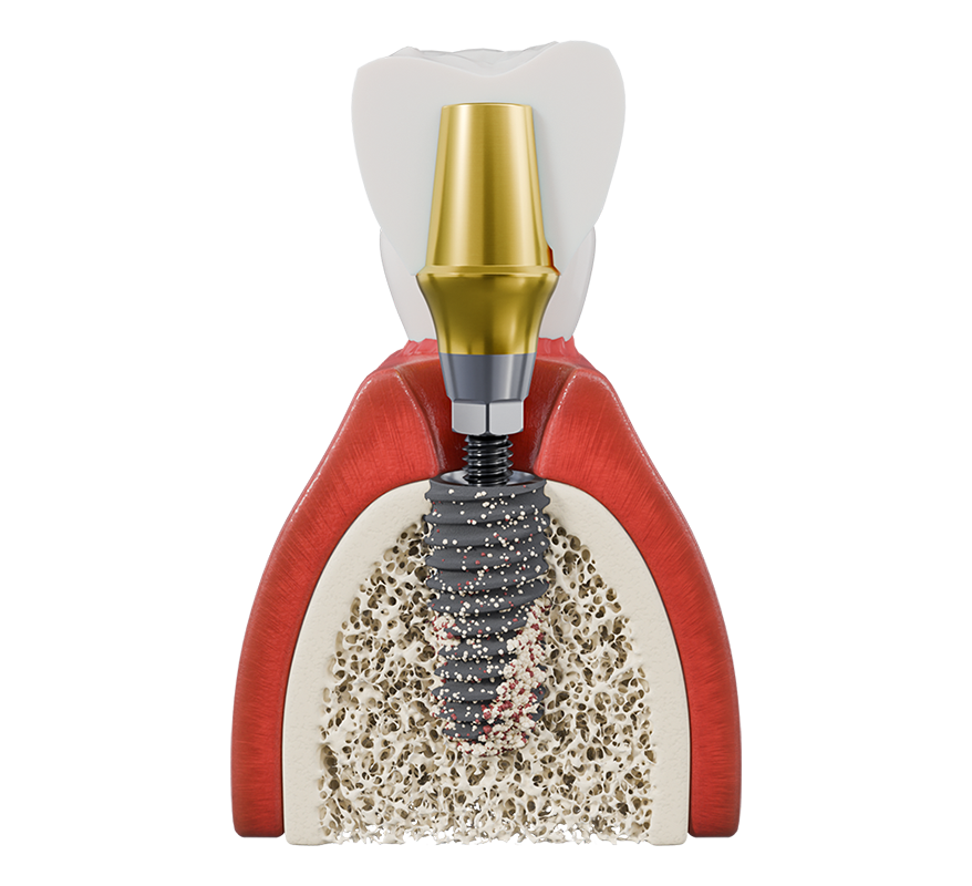 Enhance Patient Outcomes with Select Series Implant Systems img