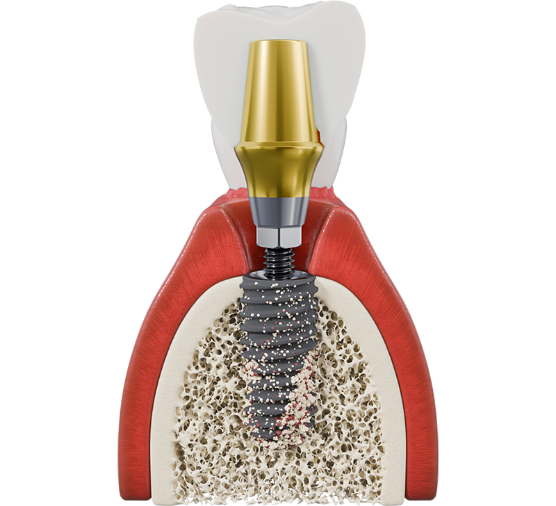 Enhance Patient Outcomes with Select Series Implant Systems img.png