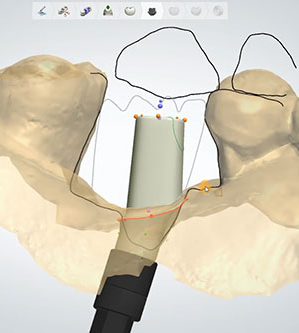 Dental Implant Fabrication and Design: Creating Custom Solutions
