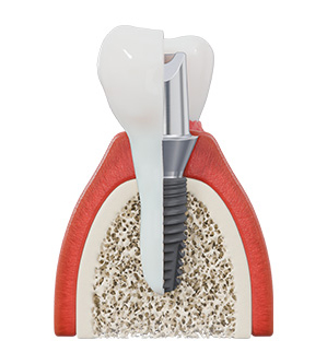 Dental Implants and Restorations: The Ultimate Smile Solution