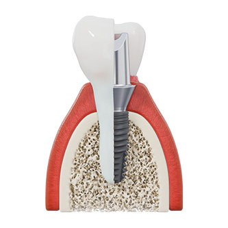 Dental implants and restorations.jpg