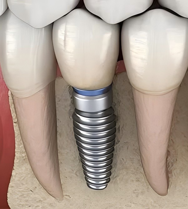 Differences between dental implants and natural teeth