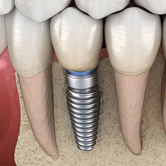Differences between dental implants and natural teeth.jpg