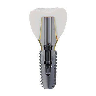 Implant fixation system (2).jpg