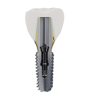 Find the Best Implant Fixation System for Dental Procedures