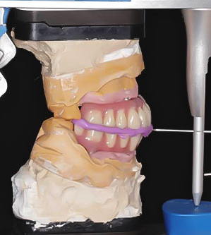 Improve Implant Impressions with Our Support System - Shop Now