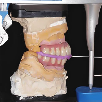 Implant Impression Support System.jpg