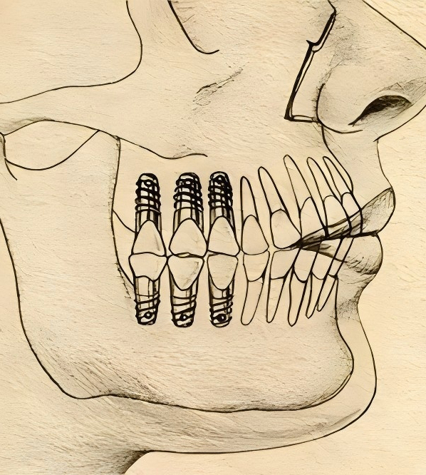 Enhance Your Quality of Life with Long-Lasting Implant Solutions