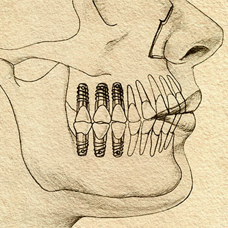 Implant life.jpg