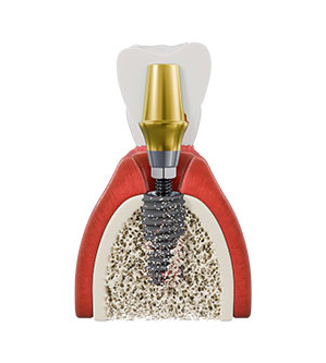 Understanding the Principles of Dental Implant Procedures