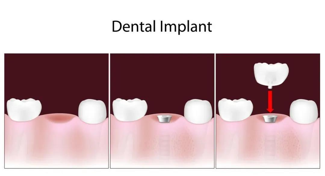 Will freedom of dental implants become a reality Dental implants will be included in centralized purchasing (3).jpg