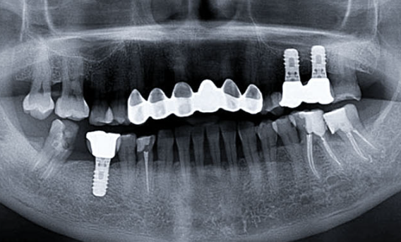 Zhuo Shiyou Implant System Clinical Cases Issue 5 (1).png