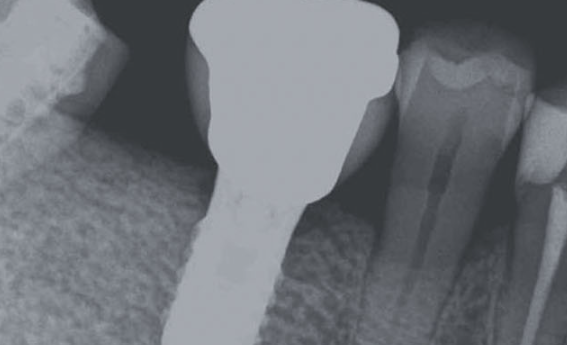 Zhuo Shiyou Implant System Clinical Cases Issue 5 (2).png