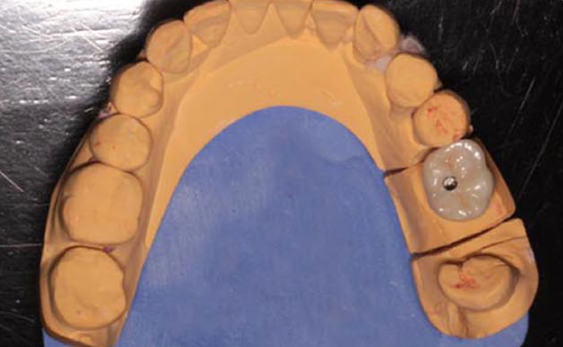 Zhuo Shiyou Implant System Clinical Cases Issue 5 (3).png