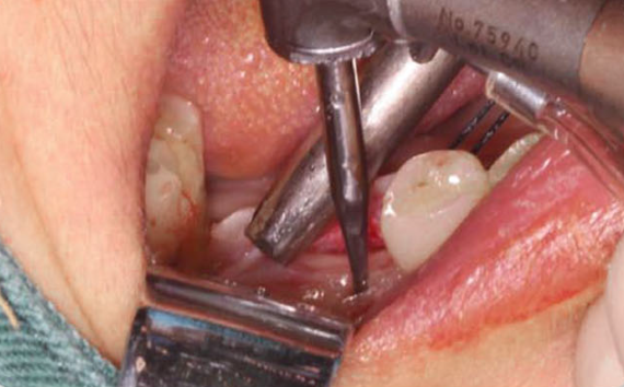 Zhuo Shiyou Implant System Clinical Cases Issue 5 (4).png