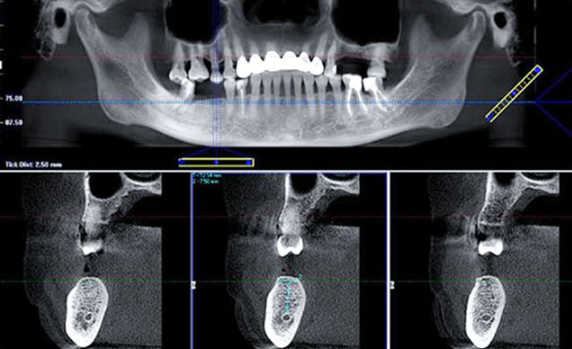 Zhuo Shiyou Implant System Clinical Cases Issue 5 (5).png