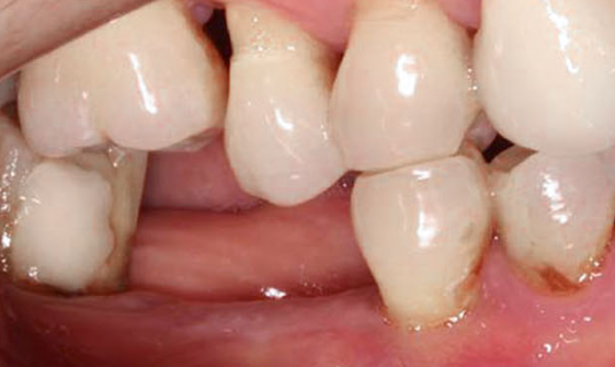 Zhuo Shiyou Implant System Clinical Cases Issue 5 (6).png