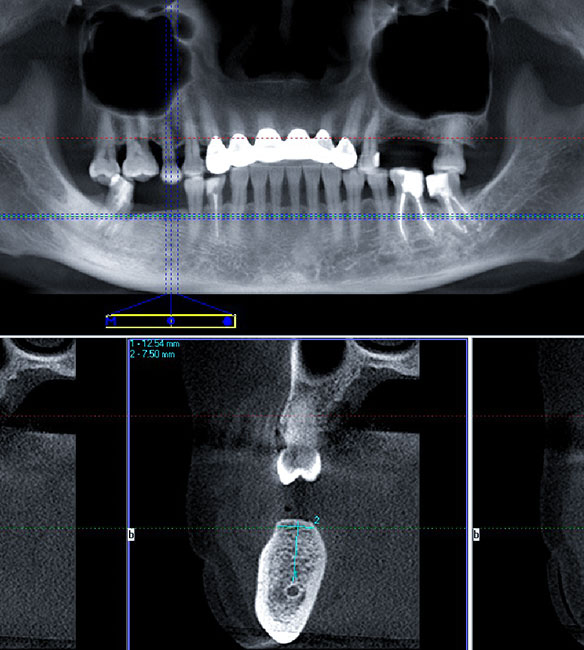 Trusyou Implant System Clinical Cases Issue 5