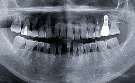 Zhuo Shiyou Implant System Clinical Cases Issue 6 (1).jpg