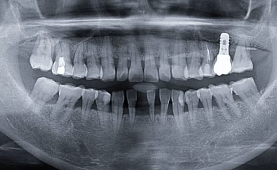 Zhuo Shiyou Implant System Clinical Cases Issue 6 (2).jpg