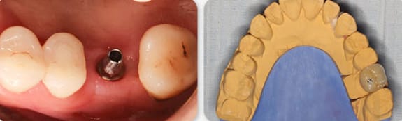 Zhuo Shiyou Implant System Clinical Cases Issue 6 (3).jpg