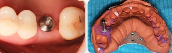 Zhuo Shiyou Implant System Clinical Cases Issue 6 (4).jpg