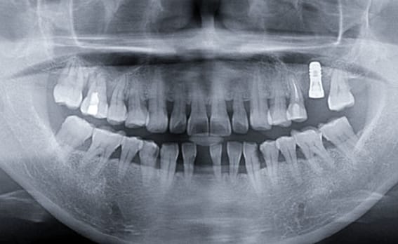 Zhuo Shiyou Implant System Clinical Cases Issue 6 (5).jpg