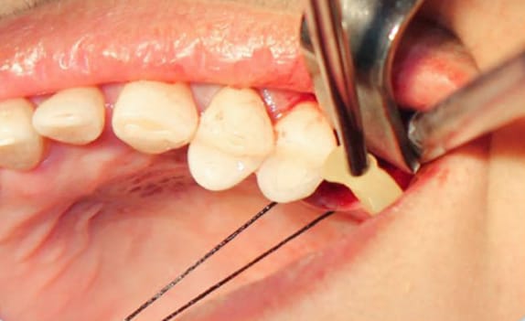 Zhuo Shiyou Implant System Clinical Cases Issue 6 (6).jpg