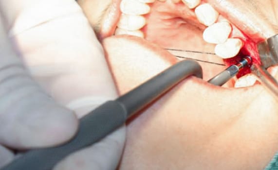 Zhuo Shiyou Implant System Clinical Cases Issue 6 (7).jpg