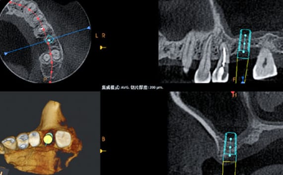 Zhuo Shiyou Implant System Clinical Cases Issue 6 (8).jpg