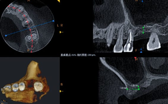 Zhuo Shiyou Implant System Clinical Cases Issue 6 (9).jpg