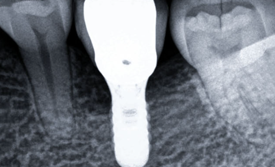 Zhuo Shiyou Implant System Clinical Cases Issue 7 (10).png