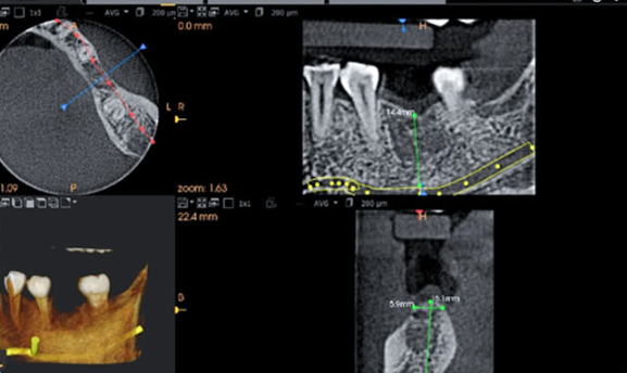 Zhuo Shiyou Implant System Clinical Cases Issue 7 (2).png