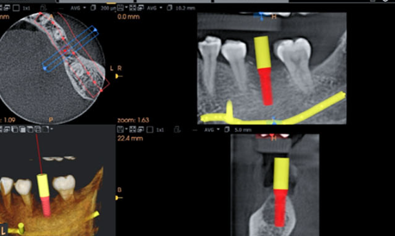 Zhuo Shiyou Implant System Clinical Cases Issue 7 (4).png