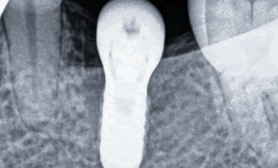 Zhuo Shiyou Implant System Clinical Cases Issue 7 (5).png
