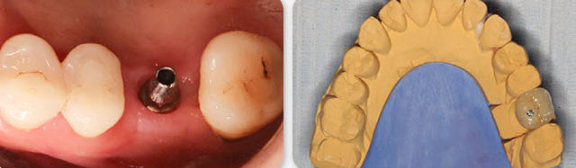 Zhuo Shiyou Implant System Clinical Cases Issue 7 (6).png