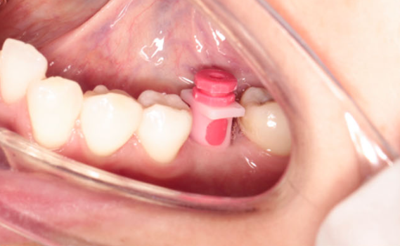 Zhuo Shiyou Implant System Clinical Cases Issue 7 (8).png