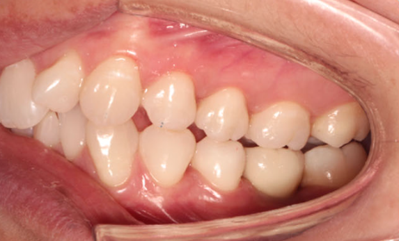Zhuo Shiyou Implant System Clinical Cases Issue 7 (9).png