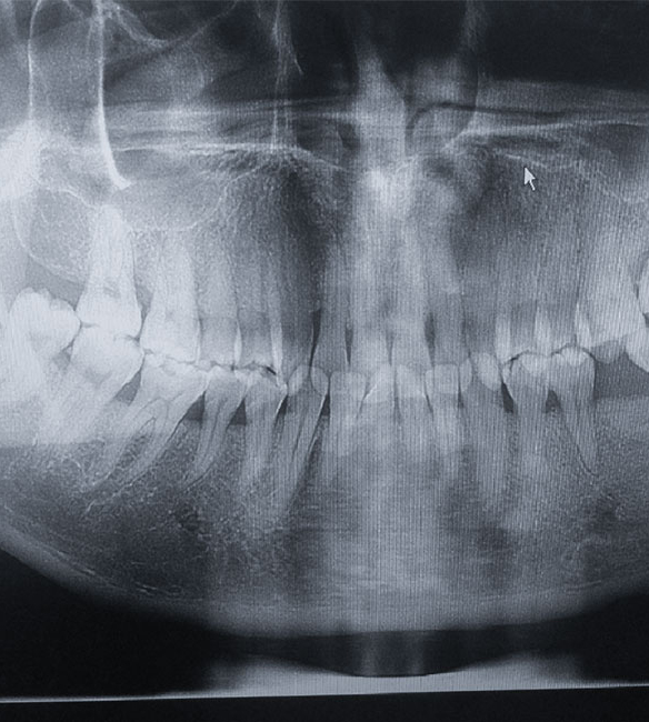 Trusyou Implant System Clinical Cases Phase 1