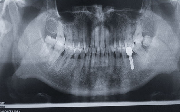 Zhuo Shiyou Implant System Clinical Cases Phase 1 (1).png