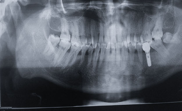 Zhuo Shiyou Implant System Clinical Cases Phase 1 (2).png