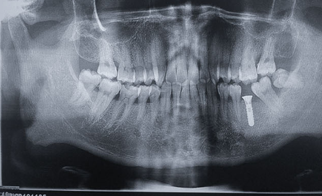 Zhuo Shiyou Implant System Clinical Cases Phase 1 (3).png