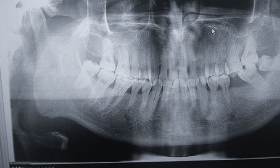 Zhuo Shiyou Implant System Clinical Cases Phase 1 (4).png