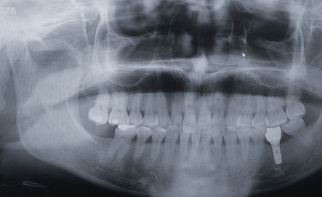Zhuo Shiyou Implant System Clinical Cases Phase 2 (2).png