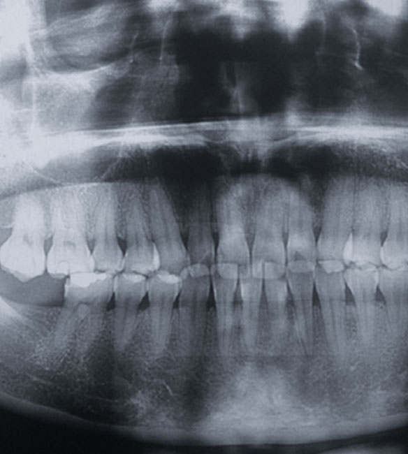 Trusyou Implant System Clinical Cases Phase 2