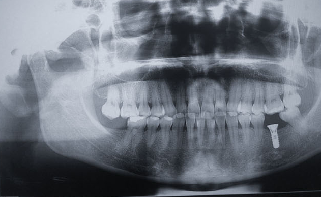Zhuo Shiyou Implant System Clinical Cases Phase 2.png