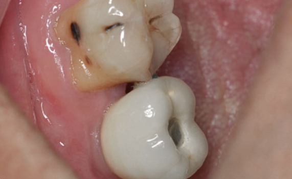 Zhuo Shiyou Implant System Clinical Cases Phase 3 (1).png